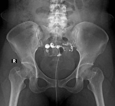 HSG test in thane | Hysterosalpingography in Thane