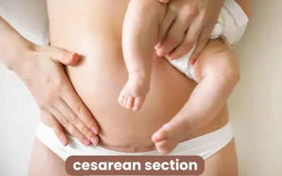 Understanding Absolute Indications for Cesarean Section