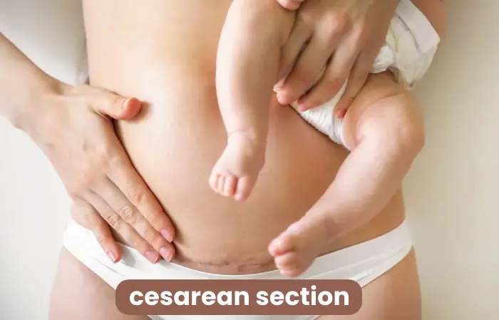 Understanding Absolute Indications for Cesarean Section