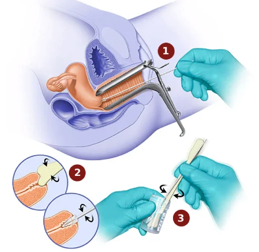 Pap smear test involves